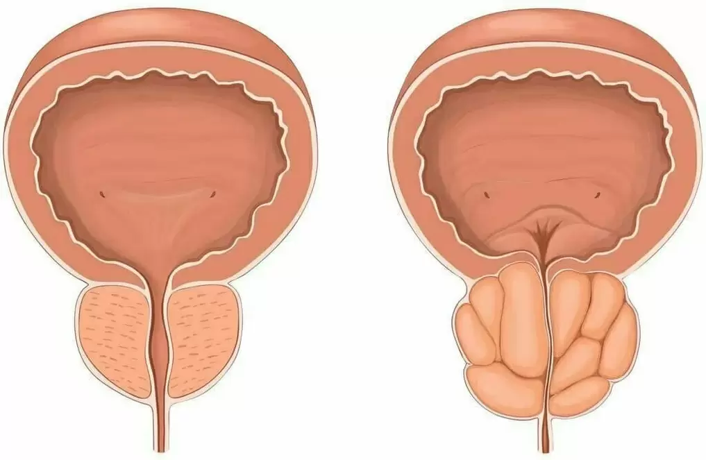 prostata normale dhe prostata e sëmurë