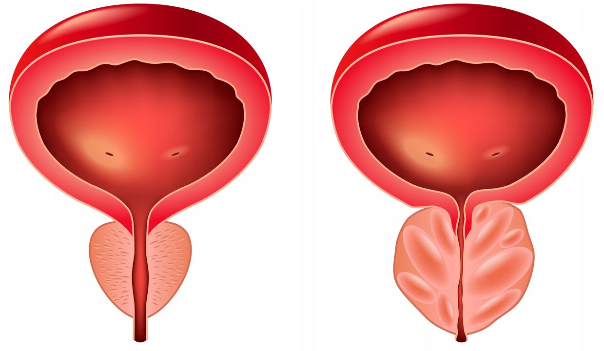 ndryshimi midis gjëndrave të prostatës